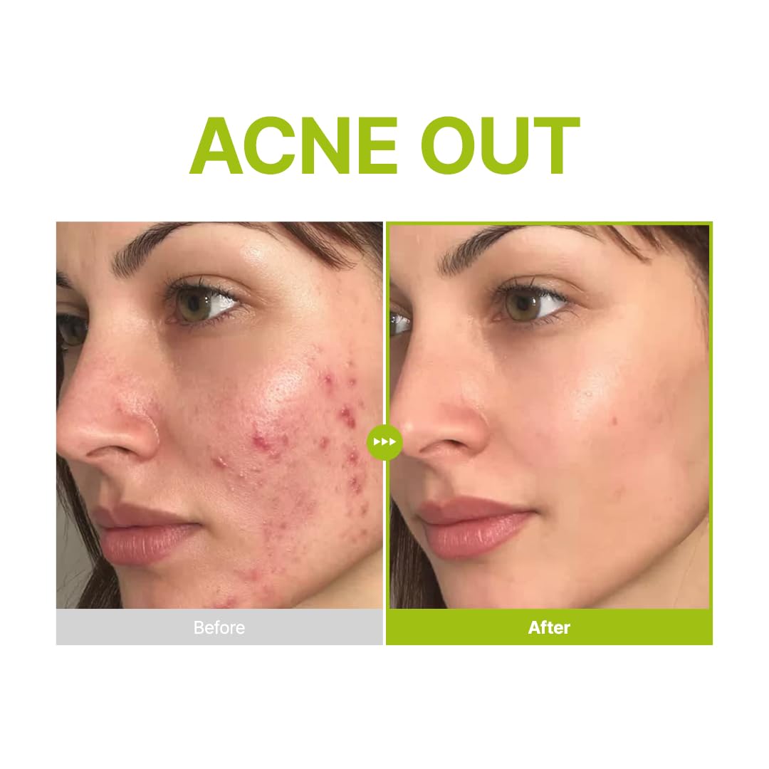 PURITO Azelaic Acid 10 Kojic Tea Tree Serum, Korean Facial Serum for Breakouts, Acne-Prone Skin, Marks, Pore Care & Even Tone, 20% Triple Active Formula with Tea Tree Capsules, 30Ml 1.01 Fl.Oz